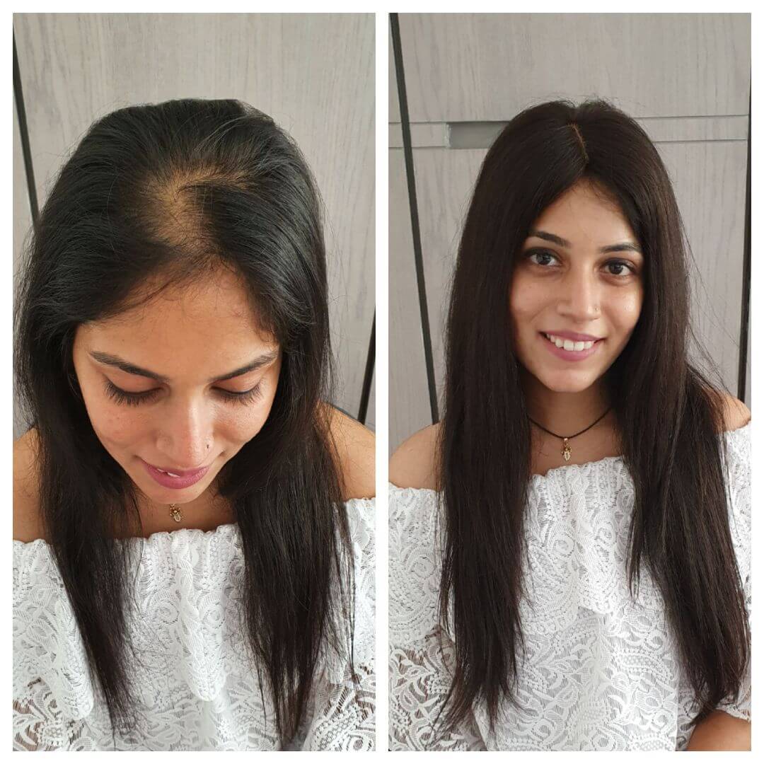 Best Quality Hair Patch - Everything You Need to Know About Hair Patch ...