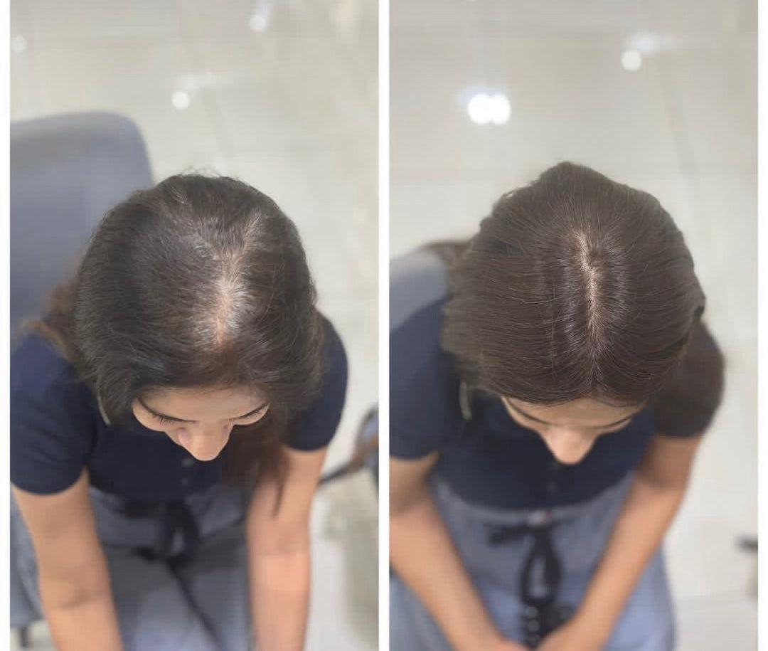 Side-by-side comparison of a woman's scalp with hair before and after wearing a 2 x 3 Silk Hair Topper.